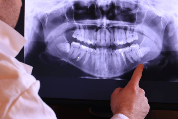 Best Emergency Dentist for Lost Fillings or Crowns in Chlicothe, IL