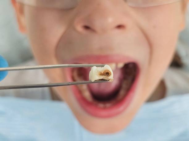 Best Emergency Dental Extractions in Chlicothe, IL