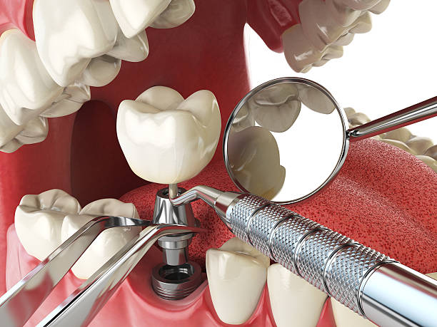 Best Emergency Dentist for Knocked-Out Tooth in Chlicothe, IL